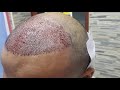 3000 grafts fue hair transplant at kochi by drsreenath