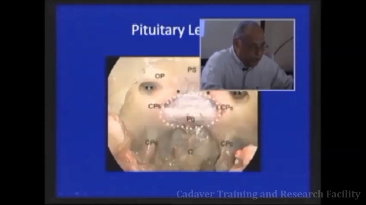 Normal Endoscopic Anatomy of Nose and PNS YouTube