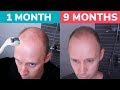 STOP BALDING! - Regrow Hair Naturally with Dermaroller! Real 9 Month Results