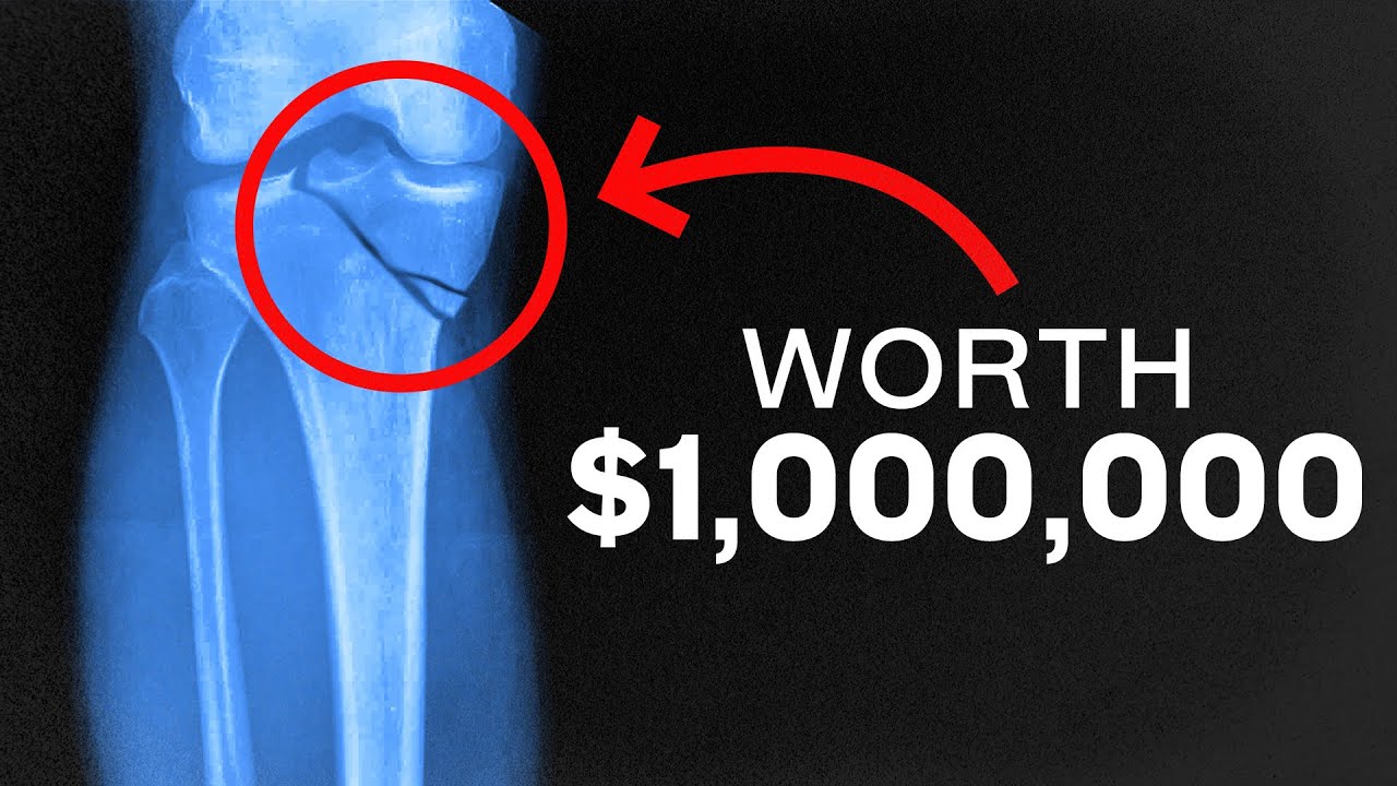 4 Surprising Injuries That May Pay You $1,000,000