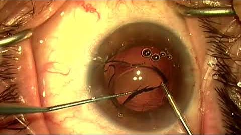 IOL exchange with ROC for ND by Steven G. Safran MD