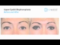 How Upper Eyelid Blepharoplasty Surgery is Performed | Dr. Thomas Buonassisi, 8 West Clinic in BC