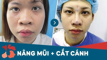 Nâng mũi cấu trúc 4D + Cắt cánh mũi