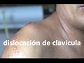 Clavícula dislocada