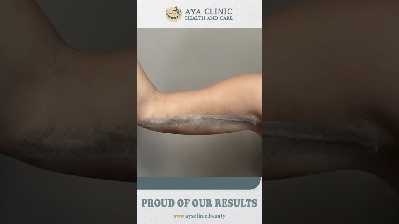 Revitalize Your Arms With Aya Clinic Leading Arm Lift Procedures In Turkey