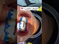 التبيض بالليزر 🦷💖 #bleaching #اكسبلور #dentition #dentalclinic #lazer