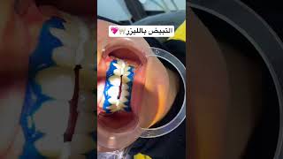 التبيض بالليزر 🦷💖 #bleaching #اكسبلور #dentition #dentalclinic #lazer