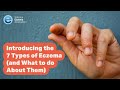 Introducing the 7 Types of Eczema (and What to do About Them)