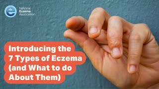 Introducing the 7 Types of Eczema (and What to do About Them)