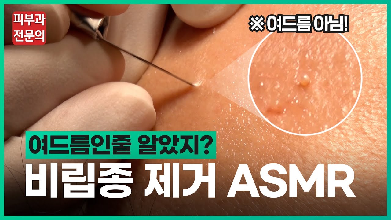 얼굴 지루성 각질 제거 방법에 대해 알아야 할 정보