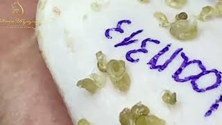 Loan Nguyen Acne Treatment 0089