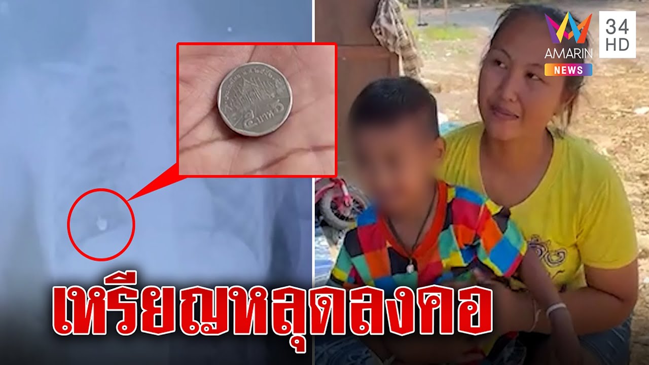 อุทาหรณ์! หนูน้อย 5 ขวบอมเหรียญ 5 หลุดลงคอเดชะบุญหมอช่วยได้ แม่ห่วงริบเงินเรียบ|ทุบโต๊ะข่าว|28/02/66