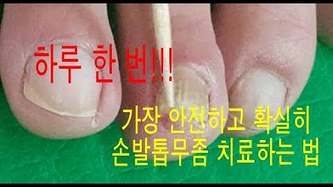 [손발톱무좀치료] 끈질긴 손발톱무좀 하루 한 번으로 가장 안전하고 확실히 치료하는 방법[발더러움주의^^] | 나이 드신 부모님에게 꼭 말씀드려 보세요~