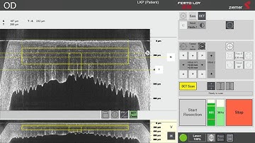 OCT guided DALK with the FEMTO LDV Z8 by Prof  Theo Seiler