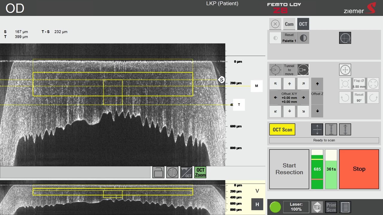 OCT guided DALK with the FEMTO LDV Z8 by Prof Theo Seiler - YouTube