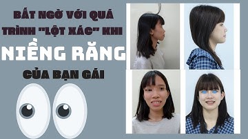 Niềng Răng Có Bị Hóp Má | Bất Ngờ Với Quá Trình "Lột Xác" Khi Niềng Răng Của Bạn Gái