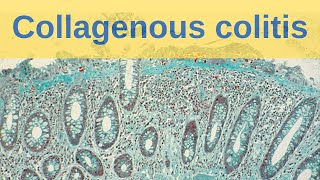 Collagenous Colitis  Pathology mini tutorial