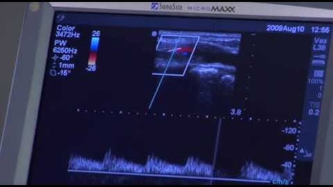 A Carotid Artery Screening - using ultrasound to detect your risk for a stroke.