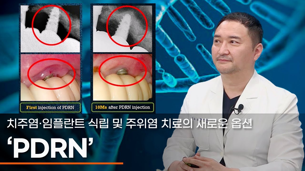 치주염·임플란트 식립 및 주위염 치료의 새로운 옵션 'PDRN'