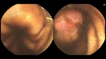 MiroCam MC2000 Double Headed Capsule Endoscopy Polypoid Distal Lesion, right side only