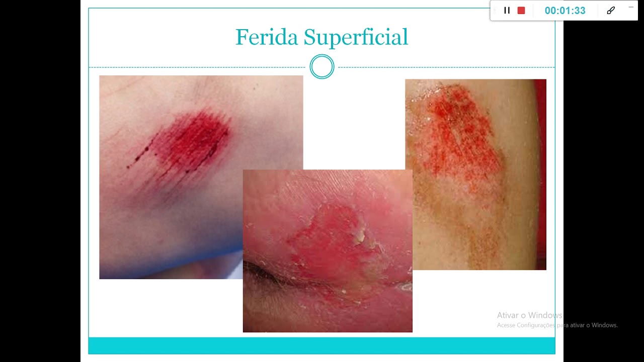 Aula L1 parte 07 Técnicas Básicas Reab. I Ferida YouTube Aula L1 parte 07 Técnicas Básicas Reab. I Ferida YouTube