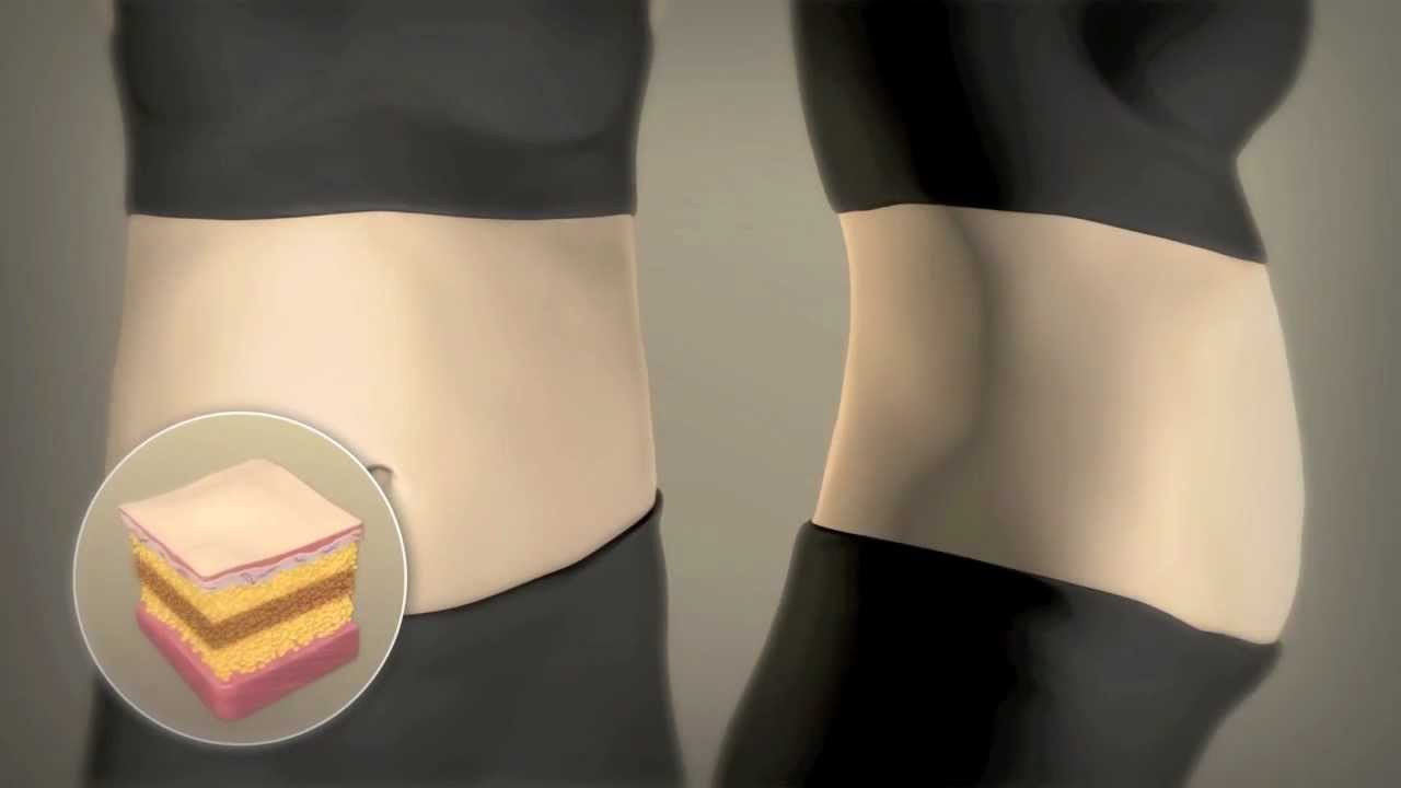 How Liposonix Works - Non Surgical Body Contouring - Liposonix Florida