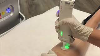 Séance Dépilation Laser Au Centre Médical Global Esthetic