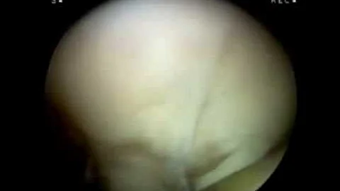 Cartilage Replacement ACI stage-1 Cartilage harvest from patient's knee video1