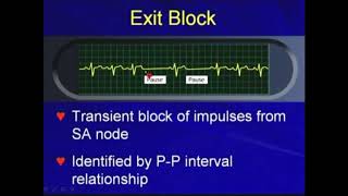 5.2.a. Exit Block - Bradyarrhythmias [Hong Kong University]