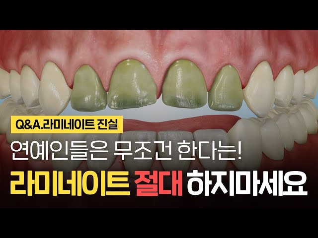 연예인들이 한다는 라미네이트, 이런분들은 절대 하지 마세요✖️