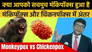 How is Monkeypox DIFFERENT from Chickenpox | मंकिपॉक्स के लक्षण |  Monkeypox SYMPTOMS