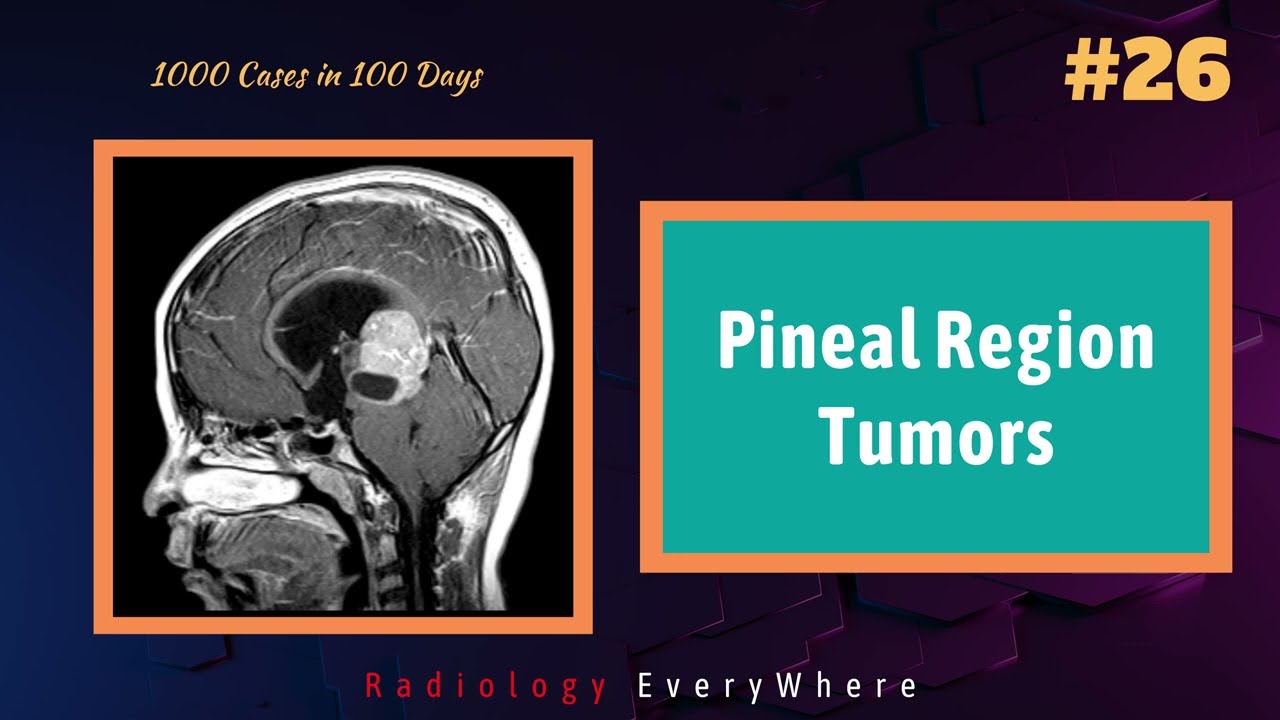 Pineal Region Tumors Pineoblastoma Germinoma Pineocytoma 1000 cases in 100 days Video
