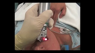 7-25.  Intubation of a Teenager Using a Straight Blade