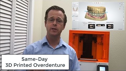 Same-Day 3D Printed LOCATOR Overdenture!!