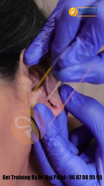 Earlobe / Hole Repair By Ear Pasting lotion / Ear Repair/ Torn Ear
