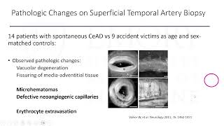 Carotid Artery Dissection: New Insights and Continued Controversies Profile