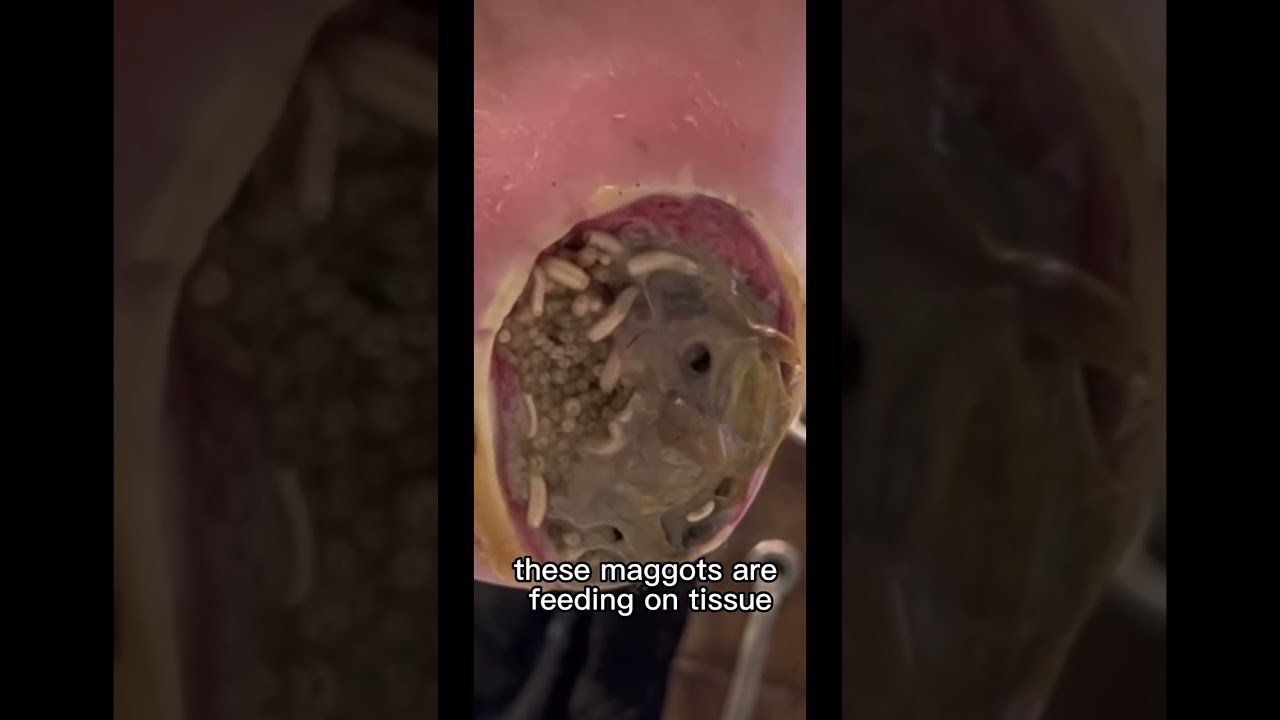 FOOT INVADED WITH MAGGOTS
