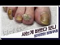 (Eng) 임신/모유수유로 무좀발톱 치료/케어 못해서 심각해진 케이스(ft. 스케일링) l Fungal/Ingrown toenails [NP케어]