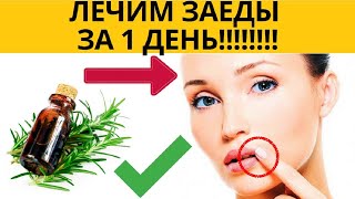 ✅ Заеды в уголках рта лечение. ✅ Чем лечить заеды в уголках. ✅ Причины заедов в уголках