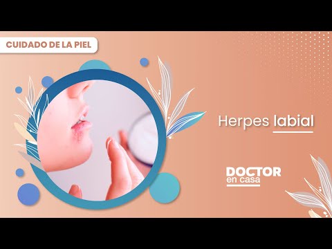Herpes labial