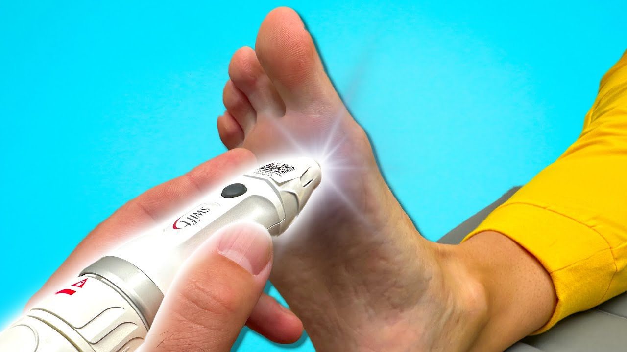 The FASTEST Wart and Corn Removal Device On The Market Swift Microwave Wart And Corn Treatment