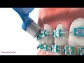Como escovar os dentes com aparelho ortodôntico / By AVA Orthodontics, powered by Ortho 2