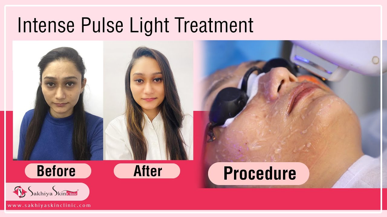 IPL Intense Pulse Light Treatment Photo Facial LaserTreatment 