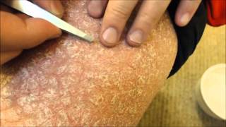 Dermatite seb