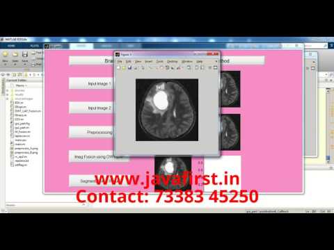 Image Fusion on Digital Images using Laplacian Pyramid with DWT