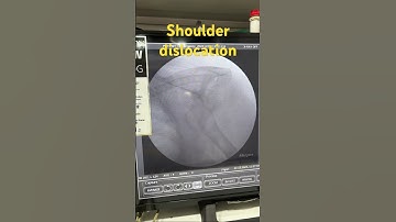 Dr yatnam  case  shoulder dislocation