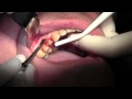 Extraction #5 with Socket Bone Grafting using d-PTFE, Flap Reflection &amp; Pouch