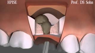 [WADE] Hydrodynamic Piezoelectric Internal Sinus Elevation (HPISE) 3D Animation