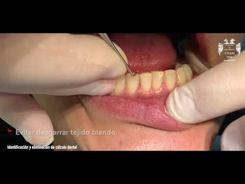 Identificación y eliminación de cálculo dental