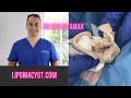 Massive abdominal cyst Dr Khaled Sadek. LipomaCyst.com